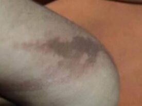 Calouros da UFPR sofrem queimaduras durante trote, em Palotina; imagens fortes