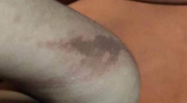 Calouros da UFPR sofrem queimaduras durante trote, em Palotina; imagens fortes