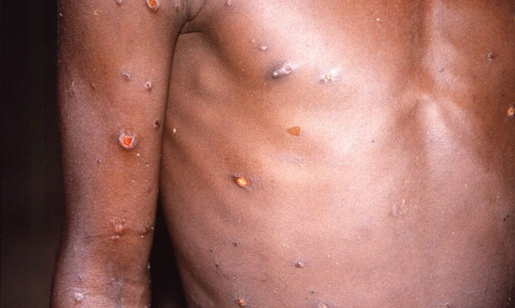 Brasil confirma terceiro caso de varíola dos macacos