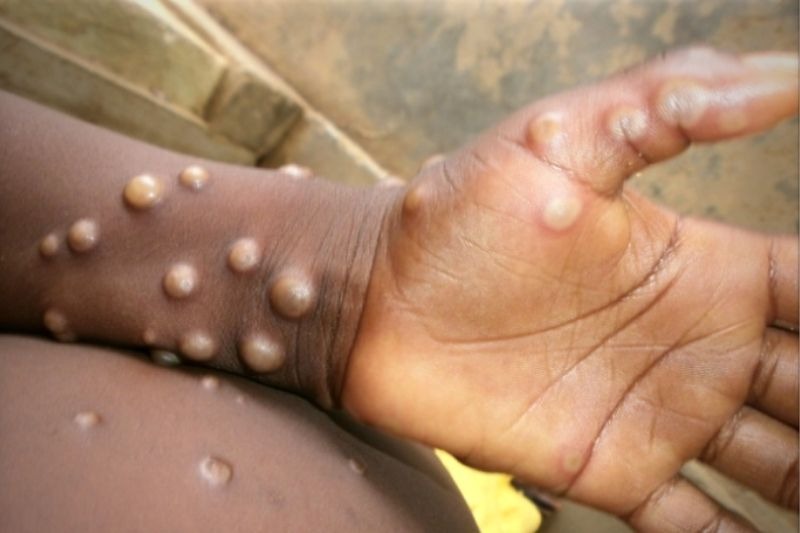 Monkeypox: Paraná confirma 5 casos novos de varíola dos macacos